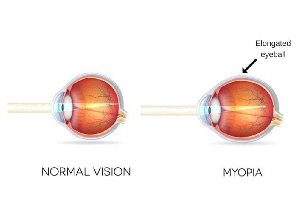 Mata normal dan miopia mata rabun