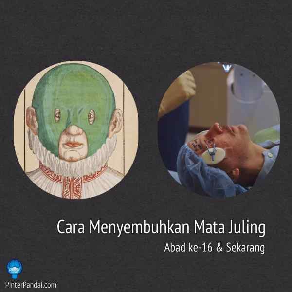 Cara Menyembuhkan Mata Juling (Strabismus) Zaman Dulu Abad 16 Dan Sekarang