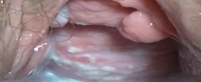 Penyebab jamur pada vagina