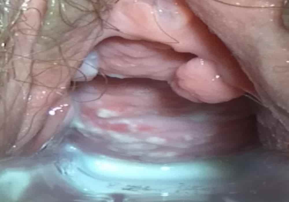 Penyebab jamur pada vagina