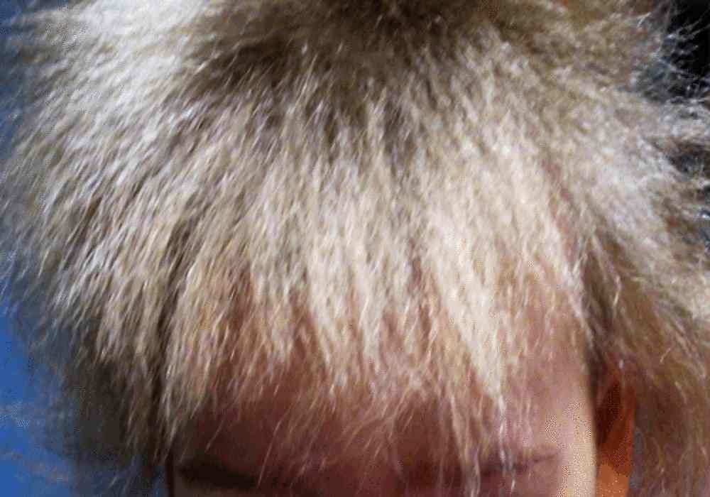 Sindrom Rambut Tidak Bisa Disisir