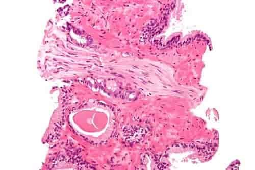 Adenokarsinoma prostat dengan invasi perineural