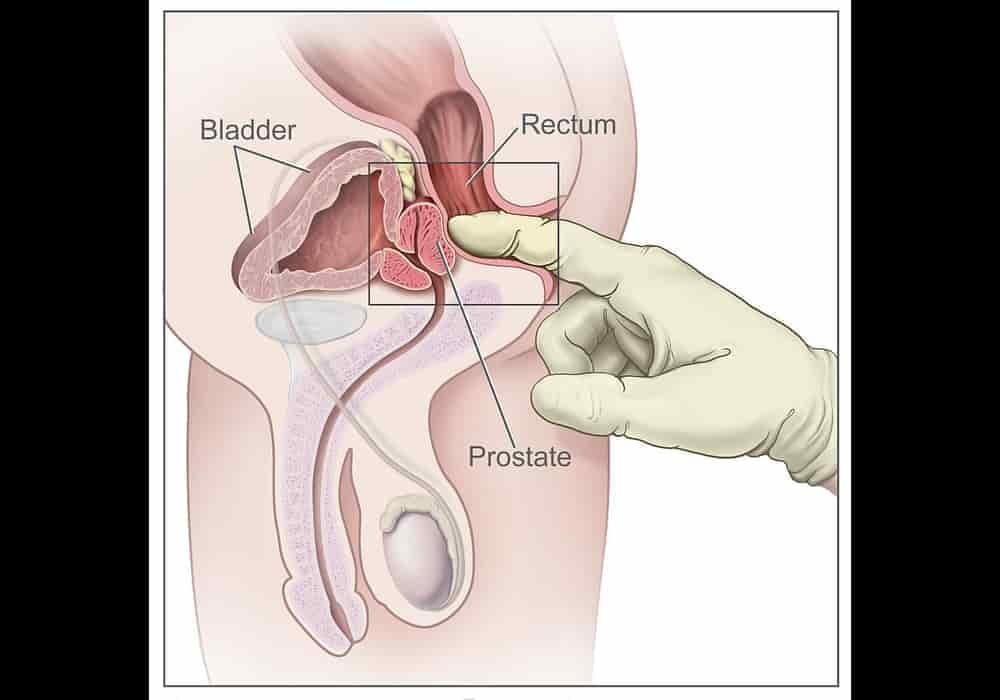 Penyakit kanker prostat