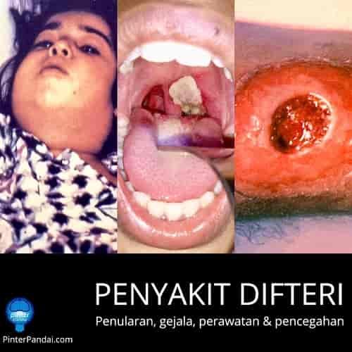 Penyakit difteri