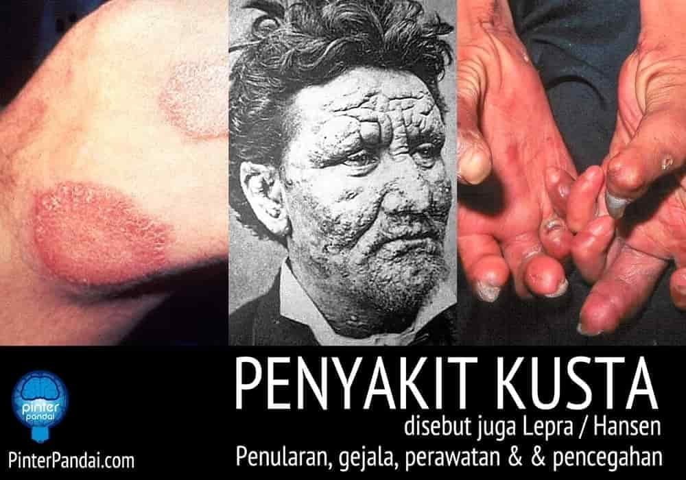 Penyakit kusta lepra hansen 2