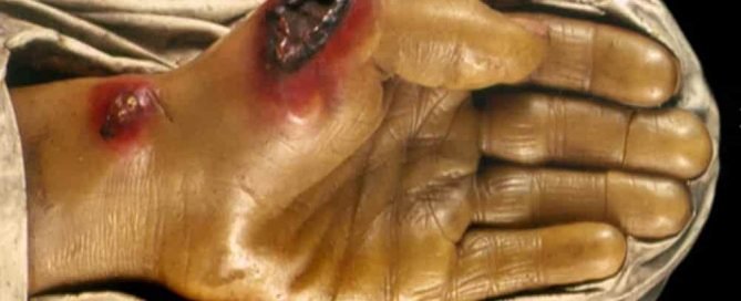 Antraks anthrax penyakit