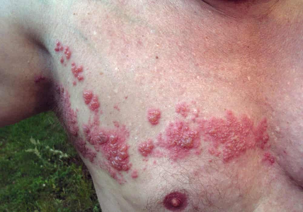 Herpes Zoster atau Shingles atau Cacar Ular - Cacar Api