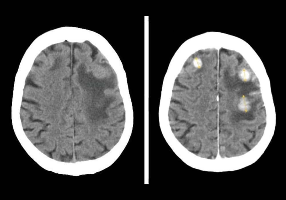 6 Tandatanda Generik Glioblastoma Kanker Otak Tergolong Ganas Yang 6 Tandatanda Generik Glioblastoma Kanker Otak Tergolong Ganas Yang