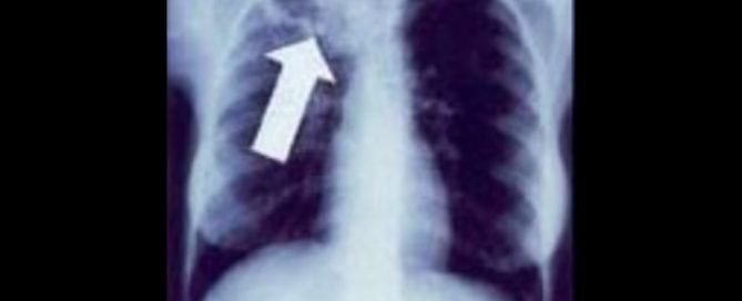 TBC Tuberkolosis