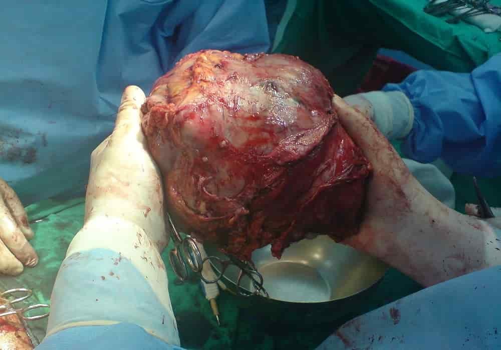 Kanker hati - Tumor hati besar