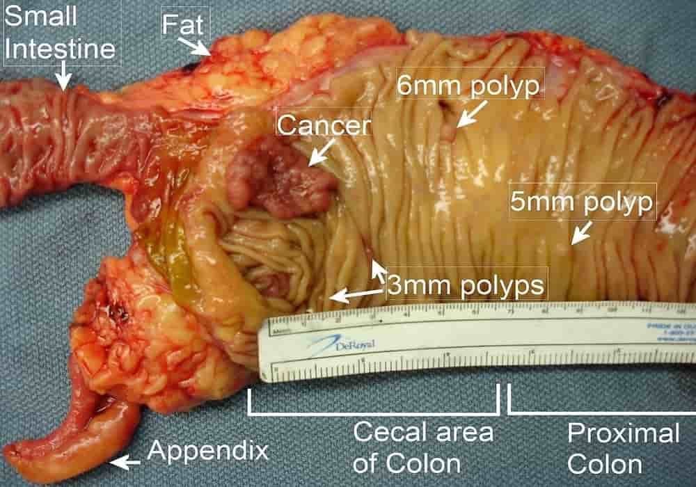 Kanker usus besar kolorektal