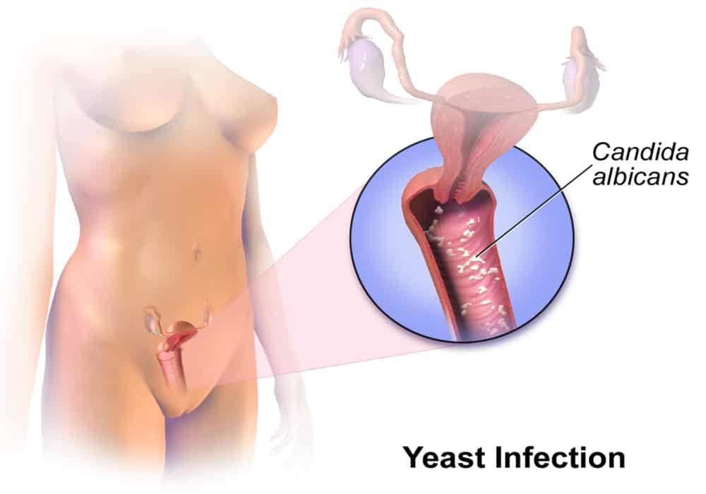 Infeksi ragi vagina Yeast infection