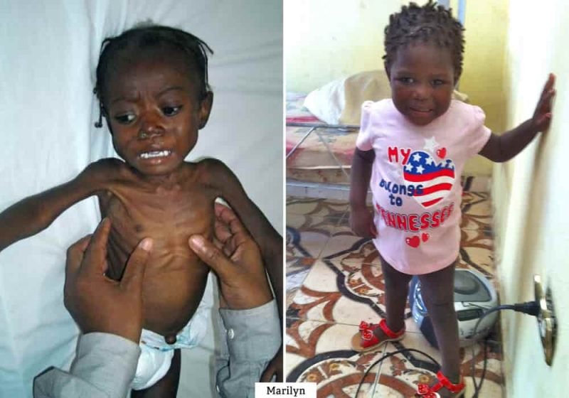 Penyakit Busung lapar Kwashiorkor terjadi pada anak