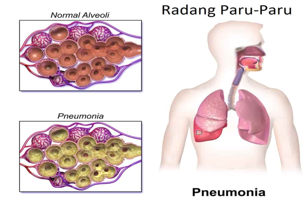 Kondisi paru-paru mengalami pembengkakan terjadi pada orang yang memiliki gangguan penyakit