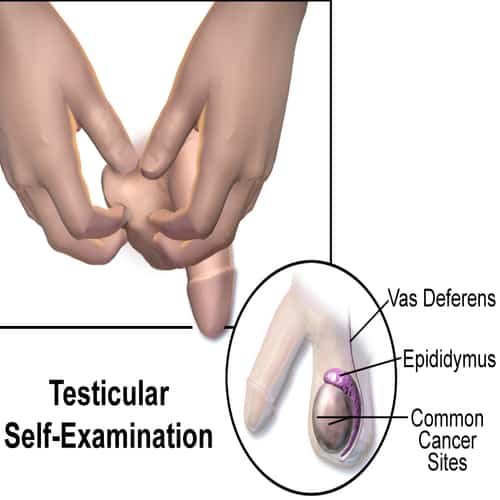 Kanker testis