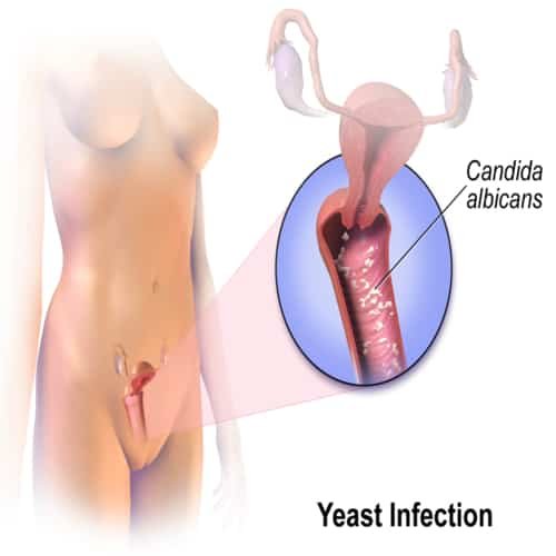 Infeksi ragi vagina Yeast infection