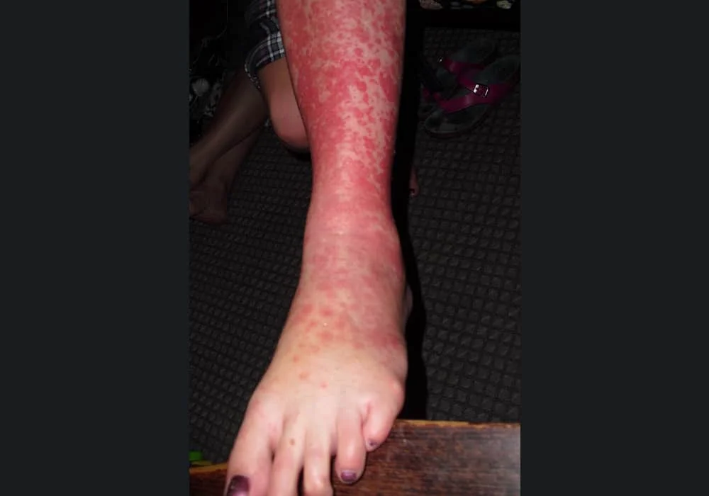 Penyakit EMM - erythema multiforme major