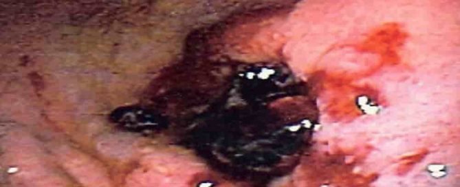 Tukak lambung gastric ulcer, salah satu penyebab muntah darah