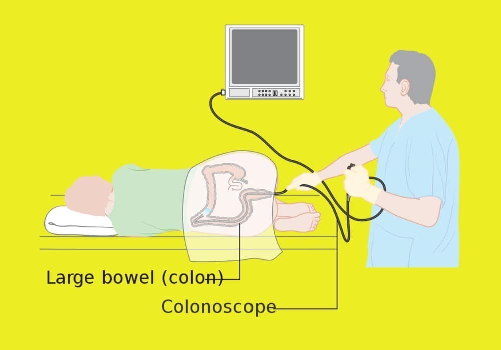 Kolonoskopi: Definisi, Persiapan dan Prosedur Pemeriksaan