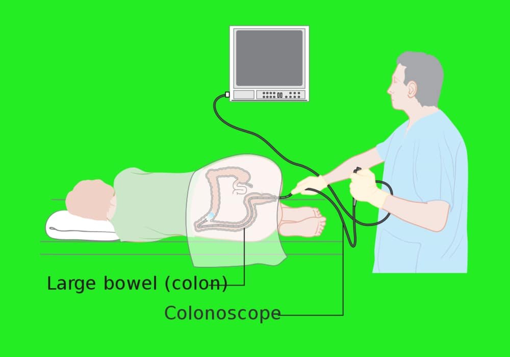Bagaimana Sebaiknya Anda Mempersiapkan Kolonoskopi