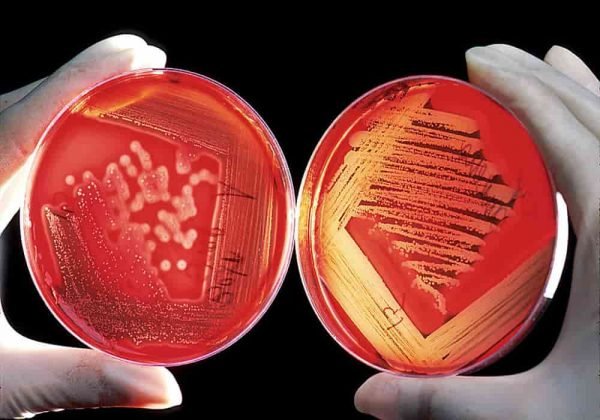 Anemia - Penyakit Kekurangan Darah Merah - Penyebab, Gejala, Obat