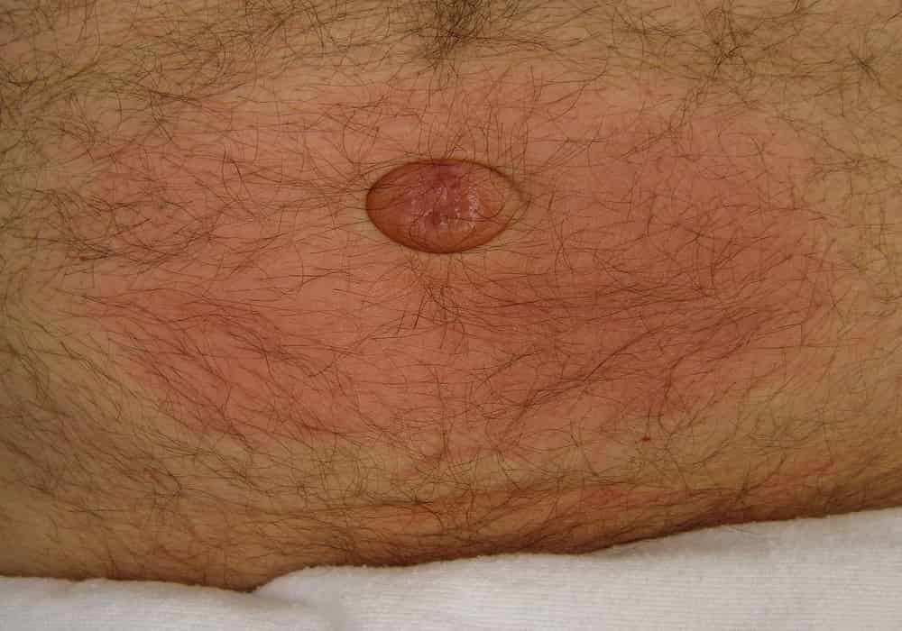 Jenis hernia umbilikalis