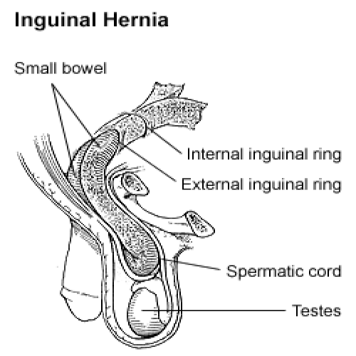 Jenis Hernia inguinalis
