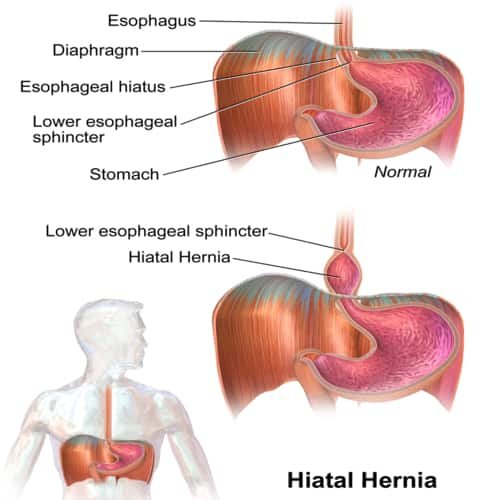 Jenis hernia hiatus