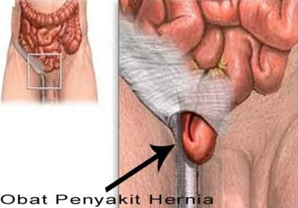 Pengobatan Hernia atau Turun Berok Beserta Solusinya