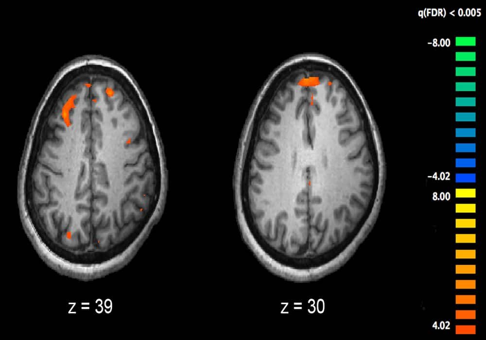 Skizofrenia adalah penyakit mental yang memengaruhi bagaimana seseorang berpikir atau merasa