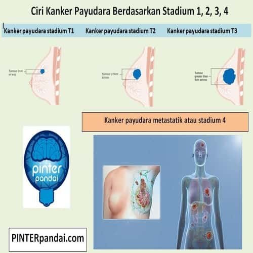 Ciri kanker payudara berdasarkan stadium - Tanda kanker payudara stadium awal