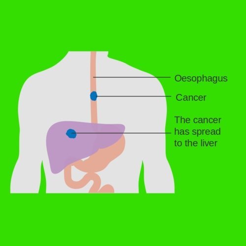 Kanker kerongkongan esofagus