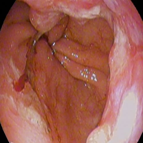 Gambar kanker kerongkongan esophageal bagian bawah