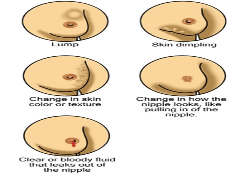 Tanda kanker payudara sejak dini