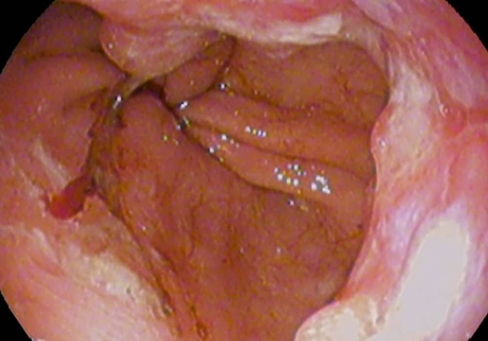 Kanker kerongkongan esophageal bagian bawah