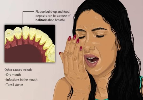 Cara Mengatasi Bau Mulut dengan Bawang Putih: Benarkah Ampuh?