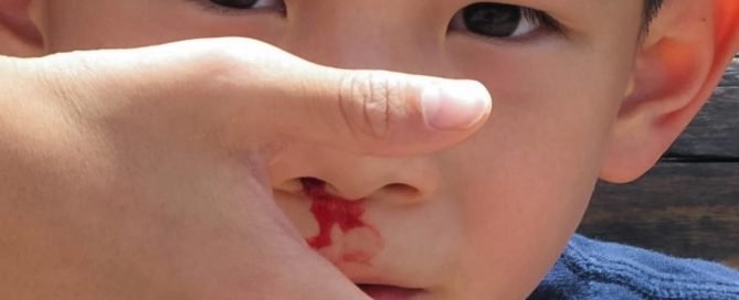 Mimisan hidung berdarah
