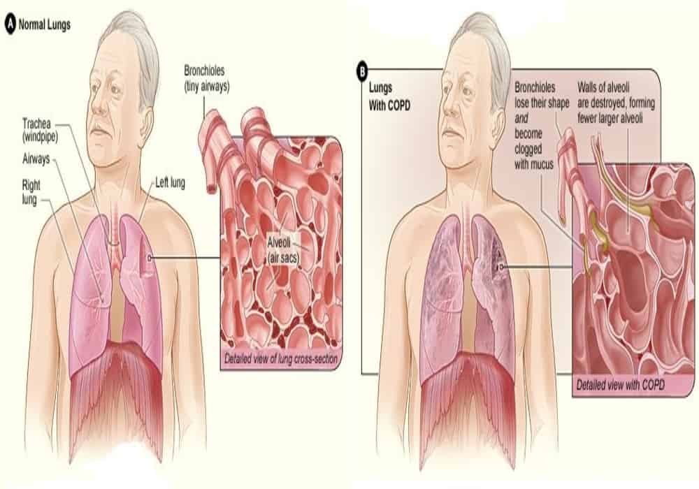 PPOK eksaserbasi akut penyakit paru obstruktif kronik