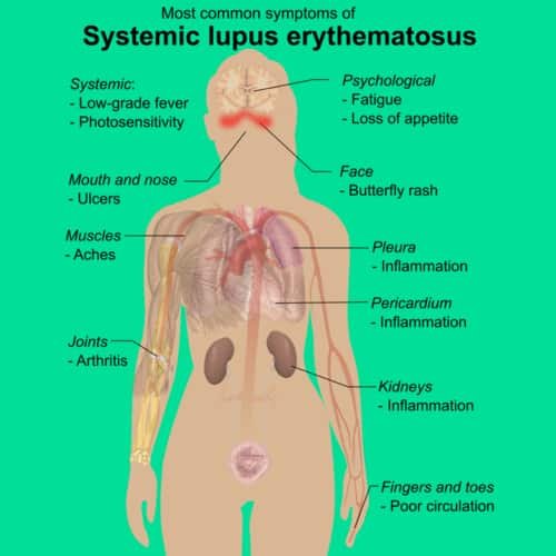 Gejala penyakit lupus SLE