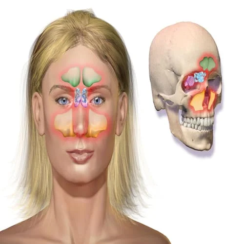 Penyakit sinusitis sinus