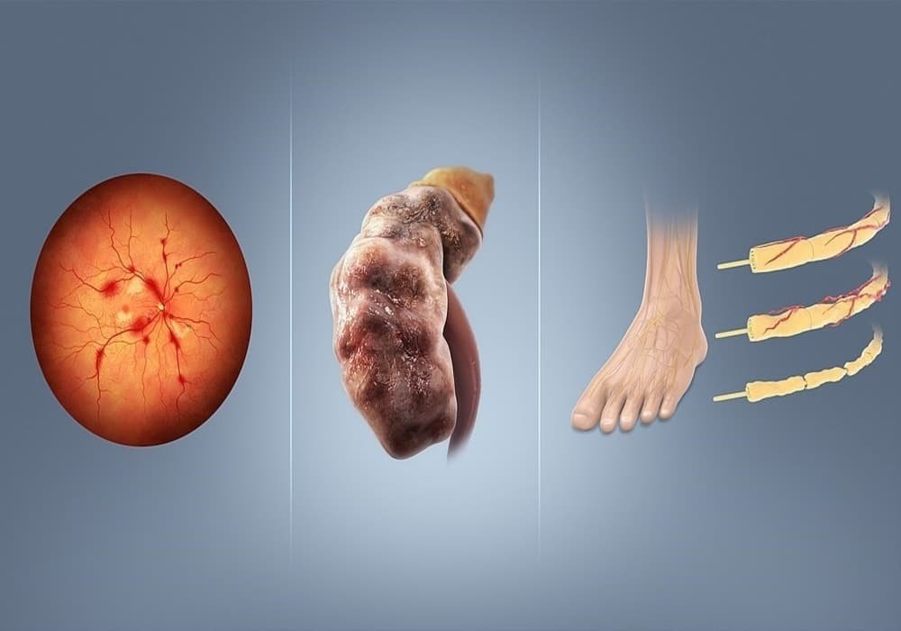 Komplikasi diabetes retinopati nefropati neuropati