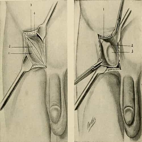 Kriptorkismus penyakit testis tidak turun