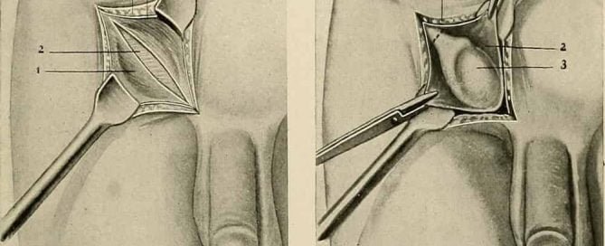 Kriptorkismus penyakit testis tidak turun