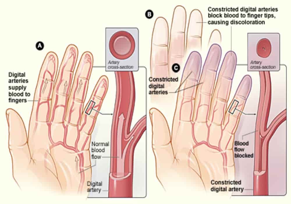 Penyakit sindrom raynaud