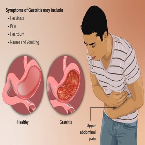 Gastritis radang lapisan lambung