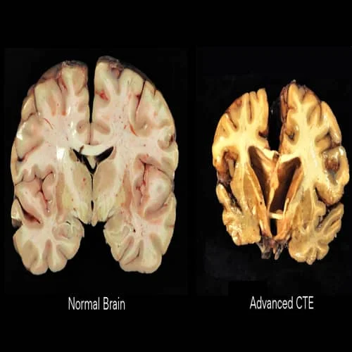 Ensefalopati trauma otak
