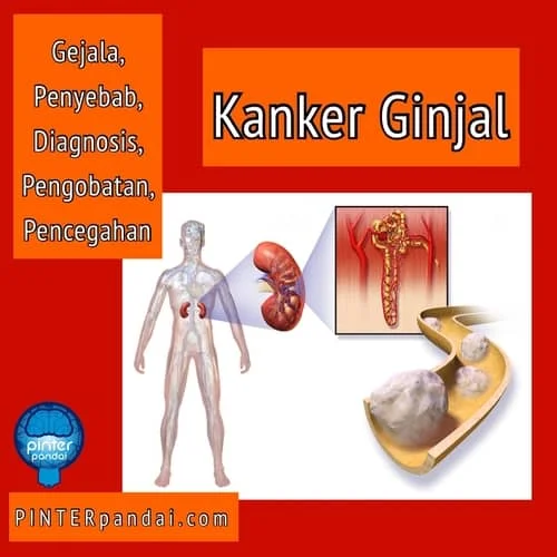 Penyakit kanker ginjal