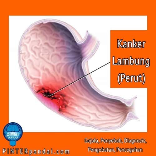 Kanker lambung perut