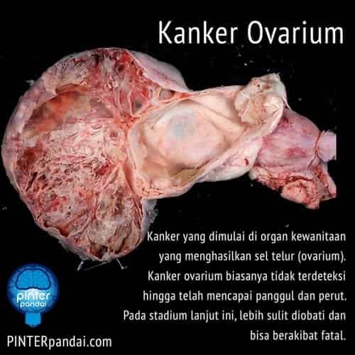 Kanker ovarium indung telur wanita