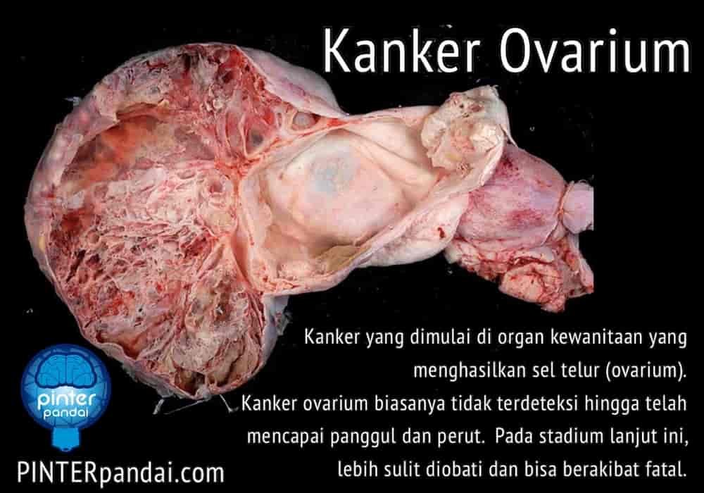 Kanker ovarium indung telur wanita